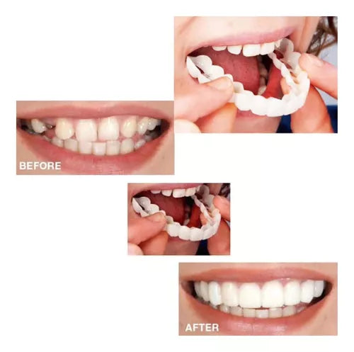 ¡TRANSFORMA TU SONRISA HOY! CARILLAS DENTALES INFERIORES Y SUPERIORES